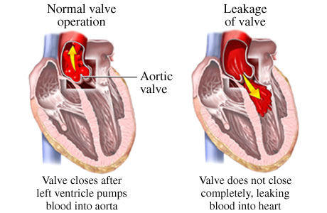 berlusconi insufficienza aortica